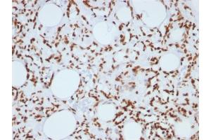 Formalin-fixed, paraffin-embedded human Angiosarcoma stained with Histone H1 Mouse Monoclonal Antibody (1415-1) (Histone H1 抗体)