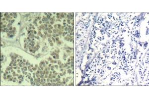 Immunohistochemical analysis of paraffin-embedded human breast carcinoma tissue using eIF2α (phospho-Ser49) Antibody (E011511). (EIF2A 抗体  (pSer49))