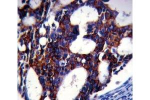 TGFB2 antibody analysis in formalin fixed and paraffin embedded human breast carcinoma. (TGFB2 抗体)
