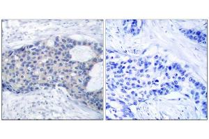 Immunohistochemical analysis of paraffin-embedded human breast carcinoma tissue, using Zap-70 (phospho-Tyr493) antibody (E011160). (ZAP70 抗体  (pTyr493))