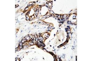 IHC-P: uPAR antibody testing of human breast cancer tissue (uPAR uPA Receptor (C-Term) 抗体)