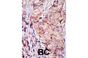 Formalin-fixed and paraffin-embedded human breast cancer tissue reacted with TRIB3 polyclonal antibody  , which was peroxidase-conjugated to the secondary antibody, followed by AEC staining. (TRIB3 抗体  (N-Term))
