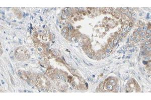 ABIN6279342 at 1/100 staining Human prostate tissue by IHC-P. (PLA2G4F 抗体  (C-Term))