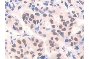 Detection of FAM19A3 in Human Breast cancer Tissue using Polyclonal Antibody to Family With Sequence Similarity 19, Member A3 (FAM19A3)