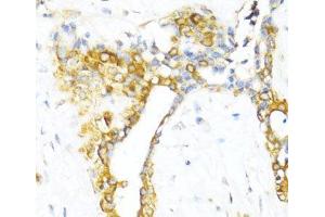 Immunohistochemistry of paraffin-embedded Human breast using CTGF Polyclonal Antibody at dilution of 1:100 (40x lens). (CTGF 抗体)