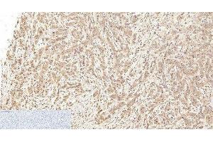 Immunohistochemistry of paraffin-embedded Human breast cancer tissue using Cleaved-CASP1 (D210) Polyclonal Antibody at dilution of 1:200. (Caspase 1 抗体  (Cleaved-Asp210))
