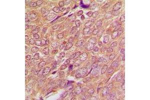 Immunohistochemical analysis of SREBP1 staining in human breast cancer formalin fixed paraffin embedded tissue section. (SREBF1 抗体)
