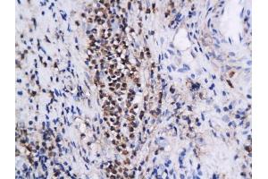 Formalin-fixed and paraffin embedded human cervical intraepithelial xenografts labeled with Anti-Annexin A1 Polyclonal Antibody, Unconjugated (ABIN731378) followed by conjugation to the secondary antibody and DAB staining (Annexin a1 抗体  (AA 281-346))