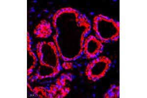 Immunofluorescence of paraffin embedded human breast cancer using p1d1 (ABIN7075069) at dilution of 1:500 (400x lens) (PLD1 抗体)
