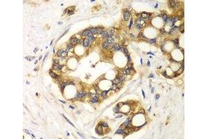 Immunohistochemistry of paraffin-embedded Human liver cancer using RPH3A Polyclonal Antibody at dilution of 1:100 (40x lens). (RPH3A 抗体)