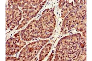 Immunohistochemistry of paraffin-embedded human ovarian cancer using ABIN7166771 at dilution of 1:100 (RBFA 抗体  (AA 201-343))