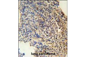ZNF197 antibody immunohistochemistry analysis in formalin fixed and paraffin embedded human lung carcinoma followed by peroxidase conjugation of the secondary antibody and DAB staining. (ZNF197 抗体  (N-Term))