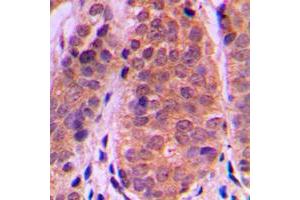Immunohistochemical analysis of Histone Deacetylase 5 staining in human breast cancer formalin fixed paraffin embedded tissue section. (HDAC5 抗体  (C-Term))