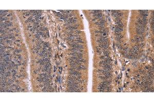 Immunohistochemistry of paraffin-embedded Human colon cancer using CLUAP1 Polyclonal Antibody at dilution of 1:50 (CLUAP1 抗体)