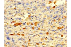 Immunohistochemistry of paraffin-embedded human melanoma using ABIN7156574 at dilution of 1:100 (IFI27L2 抗体  (AA 87-130))