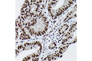 Immunohistochemistry of paraffin-embedded human colon carcinoma using Phospho-c-Jun-S73 Rabbit pAb (ABIN3019559, ABIN3019560, ABIN3019561 and ABIN1681703) at dilution of 1:100 (40x lens).