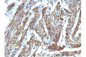 Formalin-fixed, paraffin-embedded human Uterus stained with Calponin Rabbit Polyclonal Antibody (CNN1 抗体)