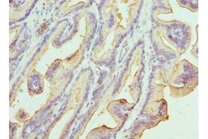 Immunohistochemistry of paraffin-embedded human prostate cancer using ABIN7157198 at dilution of 1:100 (Kallikrein 1 抗体  (AA 35-276))