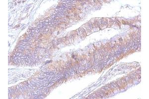 IHC-P Image eEF2 antibody detects eEF2 protein at cytosol on human colon by immunohistochemical analysis. (EEF2 抗体)