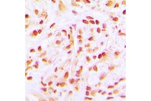 Immunohistochemical analysis of CDC16 staining in human lung cancer formalin fixed paraffin embedded tissue section. (CDC16 抗体  (C-Term))