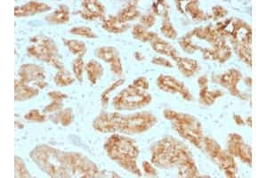 Formalin-fixed, paraffin-embedded human Prostate Carcinoma stained with AMACR / p504S Mouse Monoclonal Antibody (AMACR/1723). (AMACR 抗体)