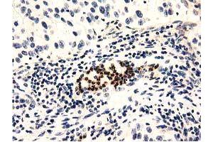 Immunohistochemical staining of paraffin-embedded Carcinoma of Human bladder tissue using anti-GAS7 mouse monoclonal antibody. (GAS7 抗体)