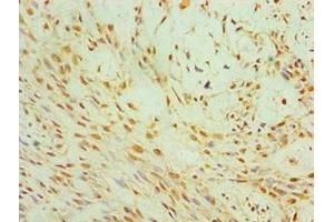Immunohistochemistry of paraffin-embedded human breast cancer using ABIN7147272 at dilution of 1:100 (CIDEC 抗体  (AA 1-238))