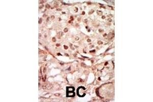 Formalin-fixed and paraffin-embedded human cancer tissue reacted with the primary antibody, which was peroxidase-conjugated to the secondary antibody, followed by DAB staining. (CDK10 抗体  (N-Term))