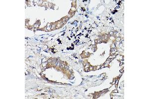 Immunohistochemistry of paraffin-embedded human lung cancer using OL Rabbit pAb (1671) at dilution of 1:100 (40x lens). (OLA1 抗体  (AA 297-396))