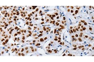 Immunohistochemistry of paraffin-embedded Human lung cancer using MUTYH Polyclonal Antibody at dilution of 1:60 (MUTYH 抗体)