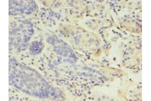 Immunohistochemistry of paraffin-embedded human gastric cancer using ABIN7158812 at dilution of 1:100 (LYZ 抗体  (AA 19-148))