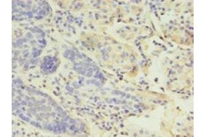 Immunohistochemistry of paraffin-embedded human gastric cancer using ABIN7158812 at dilution of 1:100 (LYZ 抗体  (AA 19-148))