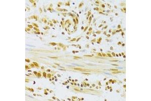 Immunohistochemistry of paraffin-embedded human gastric cancer using HMGB1 Antibody. (HMGB1 抗体  (AA 100-200))