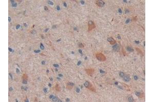 Detection of COX 2 in Human Glioma Tissue using Polyclonal Antibody to Cyclooxygenase-2 (COX 2) (COX2 抗体  (AA 418-589))