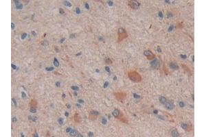 Detection of COX 2 in Human Glioma Tissue using Polyclonal Antibody to Cyclooxygenase-2 (COX 2) (PTGS2 抗体  (AA 418-589))