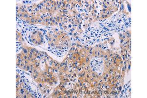 Immunohistochemistry of Human lung cancer using AGT Polyclonal Antibody at dilution of 1:30