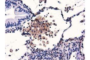 Immunohistochemical staining of paraffin-embedded Carcinoma of Human lung tissue using anti-GAS7 mouse monoclonal antibody. (GAS7 抗体)