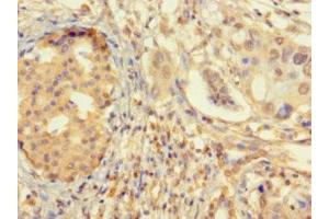 Immunohistochemistry of paraffin-embedded human pancreatic cancer using ABIN7176145 at dilution of 1:100 (ZNF2 抗体  (AA 134-289))