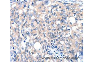 Immunohistochemistry of Human ovarian cancer using GRIN2D Polyclonal Antibody at dilution of 1:30 (GRIN2D 抗体)