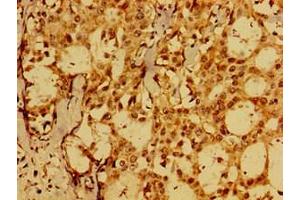 Immunohistochemistry of paraffin-embedded human breast cancer using ABIN7152575 at dilution of 1:100 (FAIM 抗体  (AA 1-179))