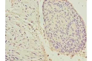Immunohistochemistry of paraffin-embedded human cervical cancer using ABIN7157360 at dilution of 1:100