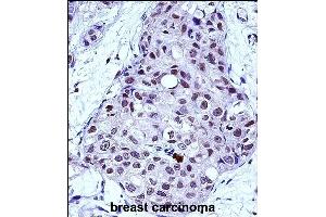 MYB Antibody (Center) (ABIN657911 and ABIN2846859) immunohistochemistry analysis in formalin fixed and paraffin embedded human breast carcinoma followed by peroxidase conjugation of the secondary antibody and DAB staining. (MYB 抗体  (AA 419-448))