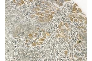ABIN6258511 and ABIN6274725 at 1/100 staining human tongue carcinoma by IHC-P. (MRPL54 抗体  (Internal Region))