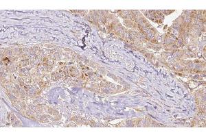 ABIN6267131 at 1/100 staining Human thyroid cancer tissue by IHC-P.
