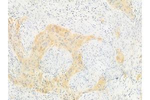 ABIN6257145 and ABIN6275079 at 1/100 staining human tongue carcinoma by IHC-P. (DNAJB11 抗体  (N-Term))