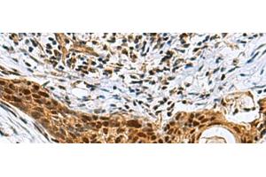 Immunohistochemistry of paraffin-embedded Human esophagus cancer tissue using NABP1 Polyclonal Antibody at dilution of 1:80(x200) (OBFC2A 抗体)
