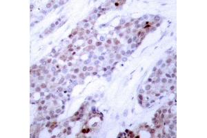 Immunohistochemistry of paraffin-embedded human breast carcinoma using Phospho-ATF4-S245 antibody (ABIN2987890). (ATF4 抗体  (pSer245))