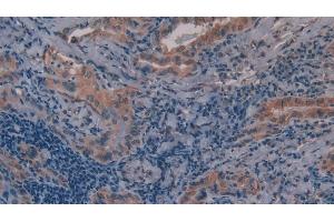 Detection of MMP11 in Human Thyroid cancer Tissue using Polyclonal Antibody to Matrix Metalloproteinase 11 (MMP11) (MMP11 抗体  (AA 277-488))