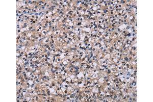 Immunohistochemistry of Human liver cancer using NR1D1 Polyclonal Antibody at dilution of 1:60 (NR1D1 抗体)