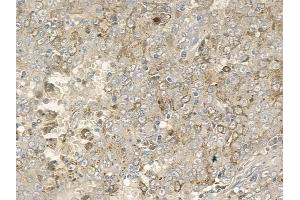 ABIN6256710 and ABIN6267163 at 1/100 staining human melanoma by IHC-P. (DLG2 抗体  (pTyr340))